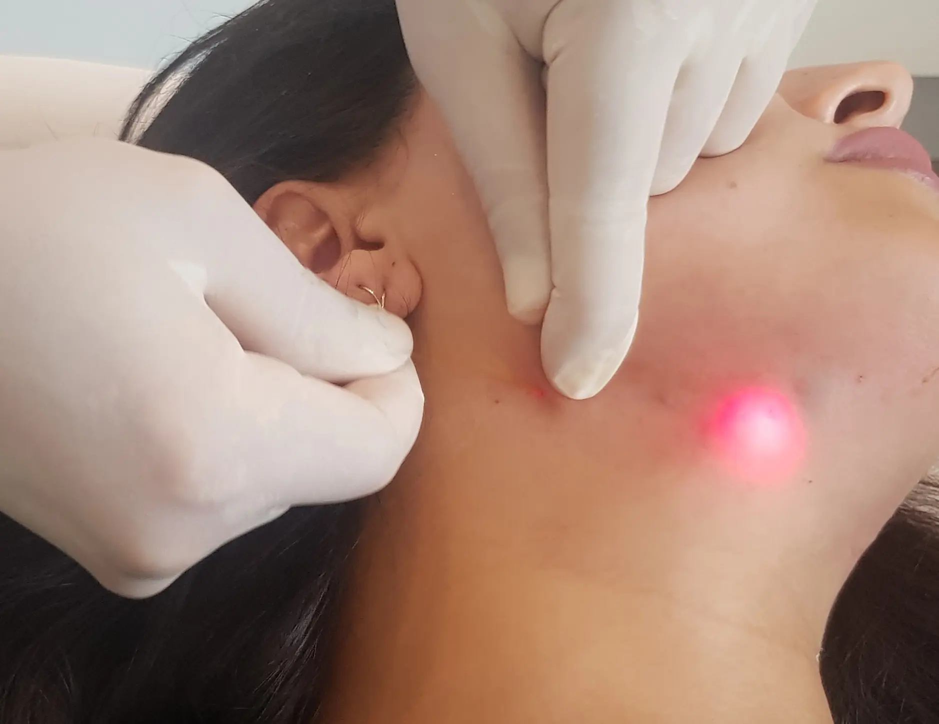 endolift_behandlung